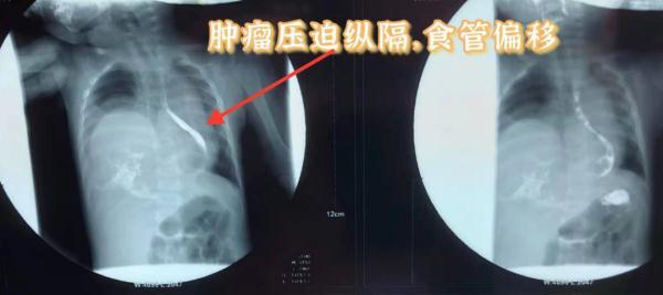 肿瘤|7月大女婴吃啥吐啥愁坏家长！一查惊呆：体内竟有个“怪胎”