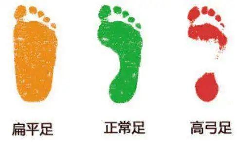 你的育儿经|一走就痛的扁平足，不仅姿势难看，还伴随O型腿、膝外翻等危害……