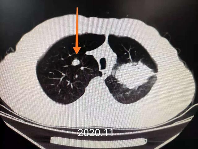 癌症生长速度有多快？等床位会导致肿瘤发展吗？看完你就懂了