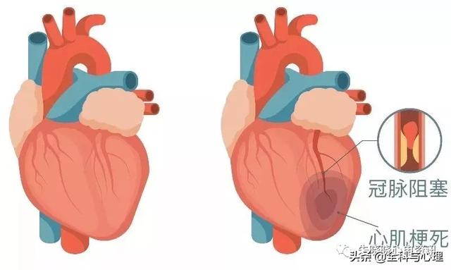 心肌梗死发作如何识别，如何自救？（附心梗地图）