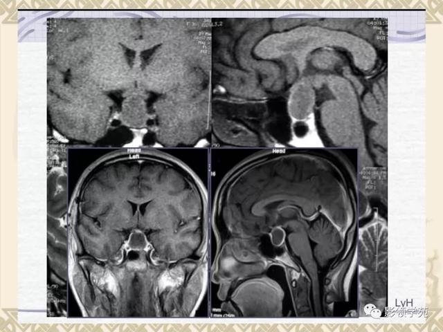 垂体病变的MRI诊断