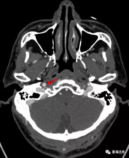 超实用的颈内动脉CTA分段