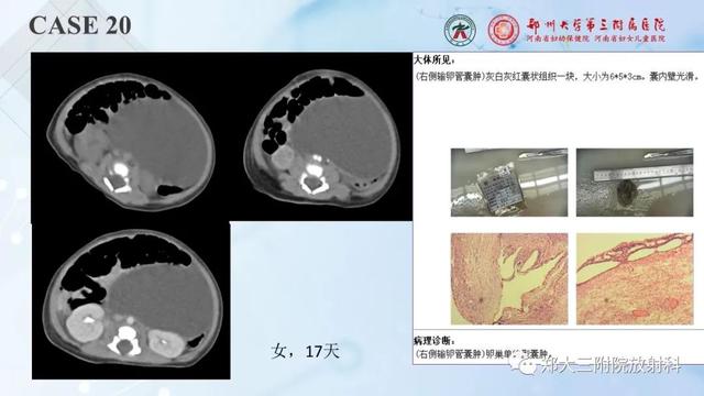 儿童腹部囊性病变诊断思路分析