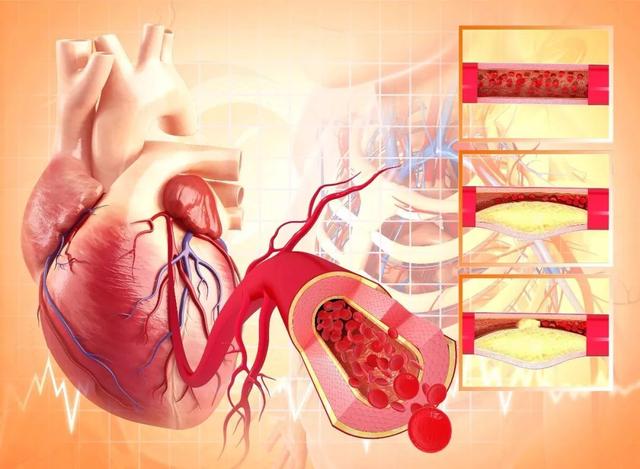 养生阁|高温加剧，冠心病患者最怕心肌梗死！医生：牢记四点，能远离心梗
