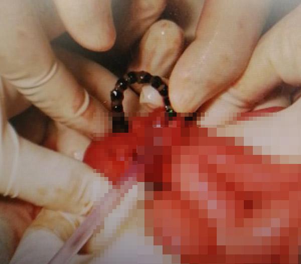 【超级宝妈】惊险！临沂2岁女童误吞15颗磁力珠受尽折磨……