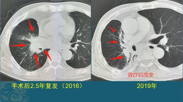 肺癌能治好吗？医生解释3个阶段的治疗数据，避免人财两空