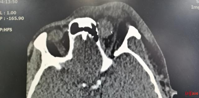 异物|0.7厘米金属渣刺入男子眼眶当场失明 医生挑战高难度手术期待复明奇迹