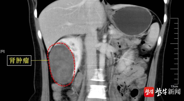肾脏|苏州一30岁女子右肾患巨大肿瘤，苏大附一院打响“肾脏保卫战”