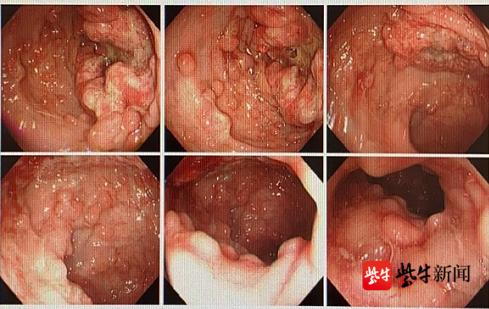 切除术|男子接连便血，竟是因为结直肠上长了数千颗息肉