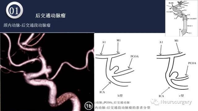 头颈动脉系统相关解剖