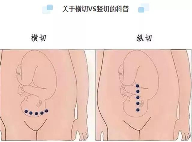 #超级宝妈#生孩子，破腹产你会选择怎么切？