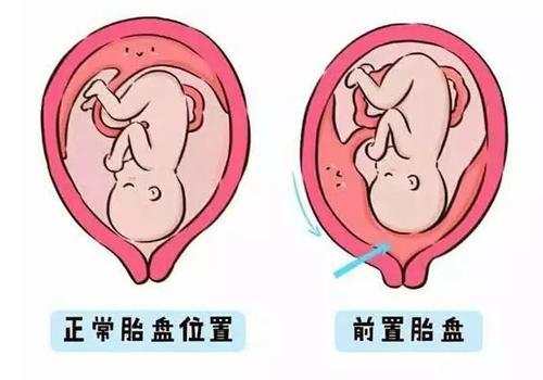 【你的育儿经】孕期胎盘前置不要害怕，孕妈做好这4点，胎盘慢慢长上去