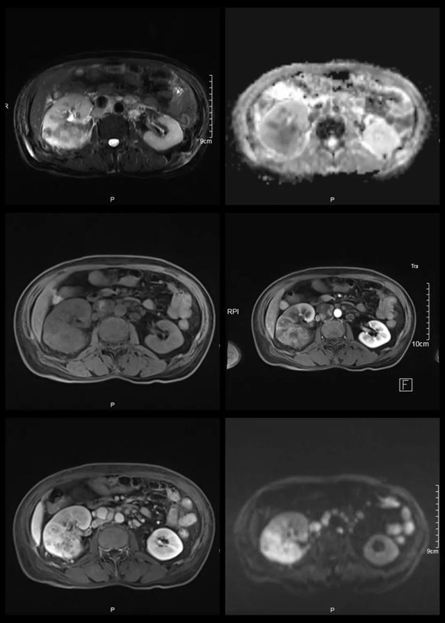 少见典型肾肿瘤一例，也容易误诊的病例