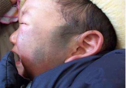 #超级宝妈#孕期避免3件事,不容易让“胎记”找上宝宝，孕妈一定要注意