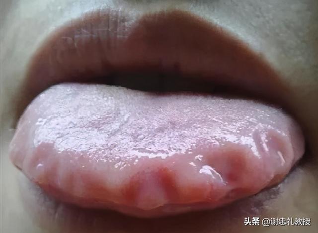 裙边舌、白腻苔！四味药的小方子，帮你化掉湿气