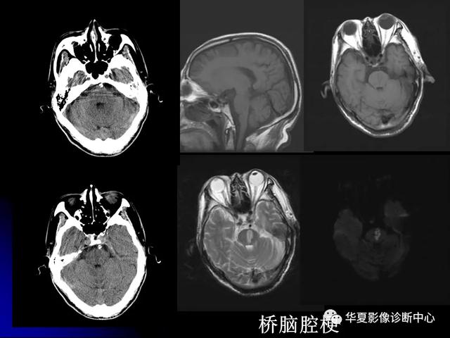 「影像复习」脑干区常见病变影像表现