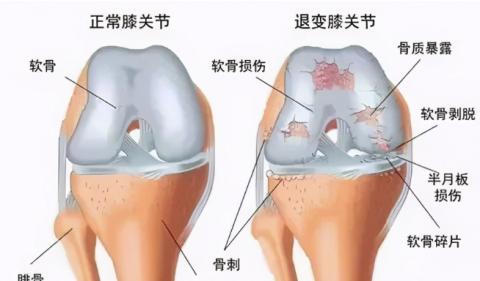 冬天做好这3点，让你的膝盖远离疼痛