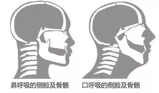 #超级宝妈#长期用嘴呼吸会变丑？宝宝有这些症状，家长要注意了