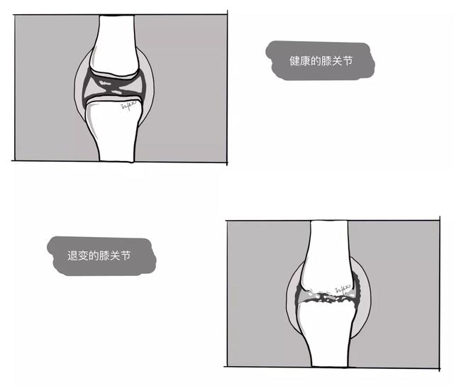 台州文化生活频道丨如何对待“肿痛”难耐的膝关节炎，骨科医生来支招