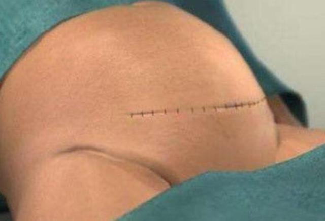 头胎剖腹产，二胎可以选择顺产吗？产科专家：做好这几点没问题