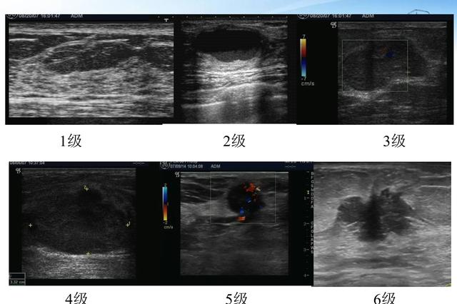 乳腺彩超报告上的BI-RADS分类提示什么？教你看懂行内术语