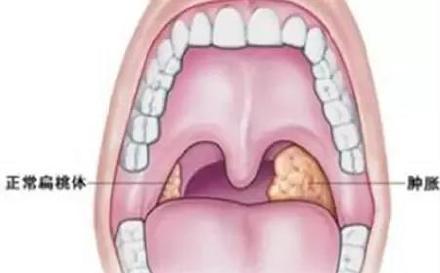 预防|如何预防慢性扁桃体炎反复发作
