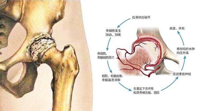 为什么冬天股骨头坏死疼痛加剧？