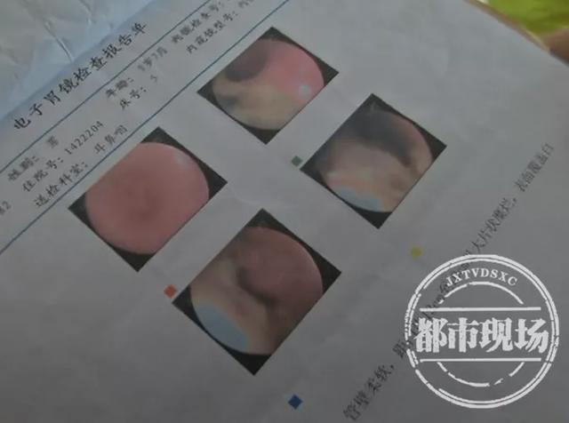 凉年|孩子一口吞下电池，食道大面积烧伤，爸爸自责不已