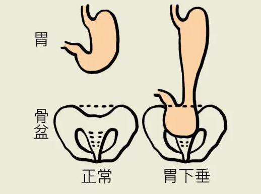 胃下垂|胃下垂不是病，只是胃比正常低，8个动作经常练可助恢复