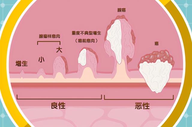 年年体检都“正常”，却还发现癌症晚期？医生：癌胚抗原不准确