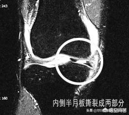 内侧半月板|为什么走平路膝关节不疼，但是打弯、下楼梯、蹲起时膝关节疼痛呢