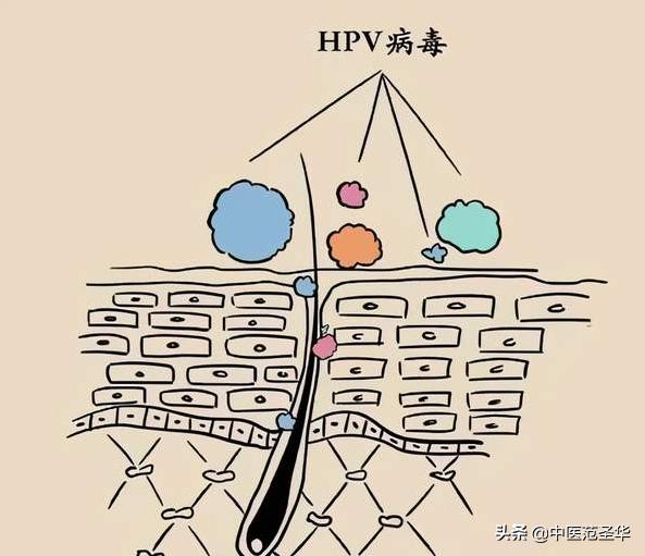 手脚颈部小肉球（皮肤疣）的能不能用手抠？如何有效治疗？