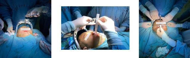 上颌骨|山东省首例！青岛妇儿医院成功开展上颌骨经颅缝外牵引术，让患儿重“绽”笑颜