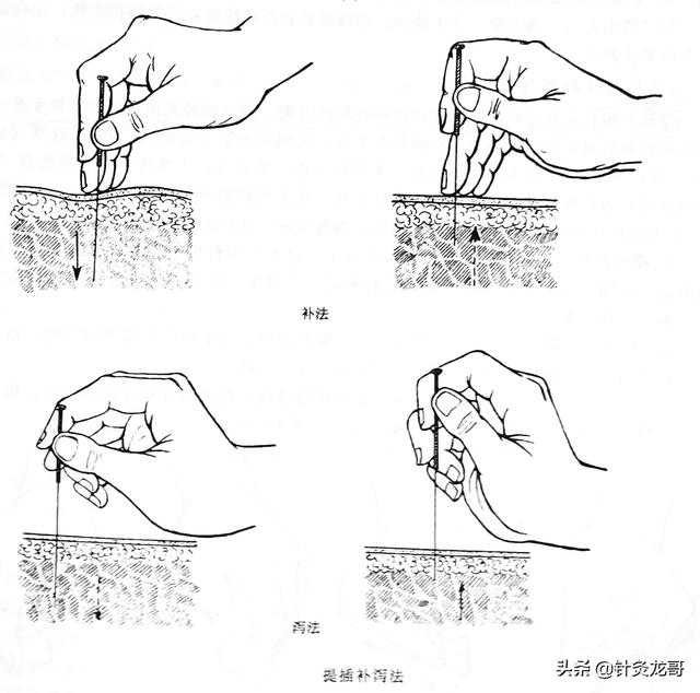 针灸常用补泻手法介绍，建议初学者收藏