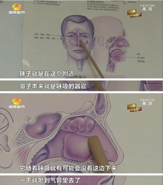 【芒果都市】长沙女童模仿“豌豆射手”，将塑料珠塞进鼻孔，险呛气管危及生命！医生提醒：家长要做好安全监护