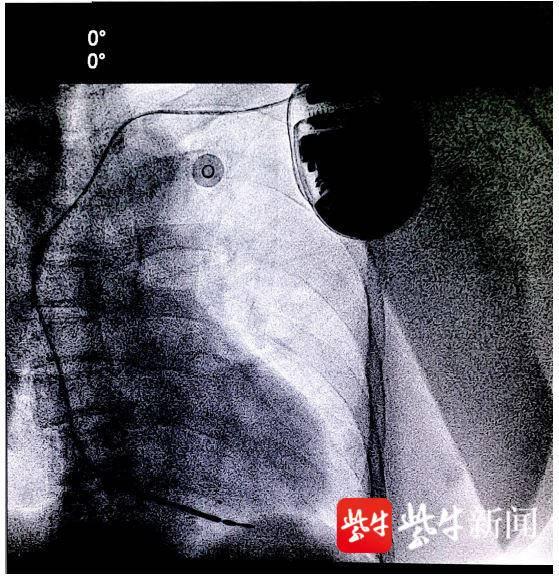 患者|江苏首台全球体积最小ICD手术在常完成