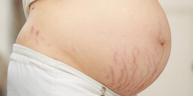 超级宝妈@40%女性产后没有妊娠纹,这是为何?教你几招,轻松告别妊娠纹