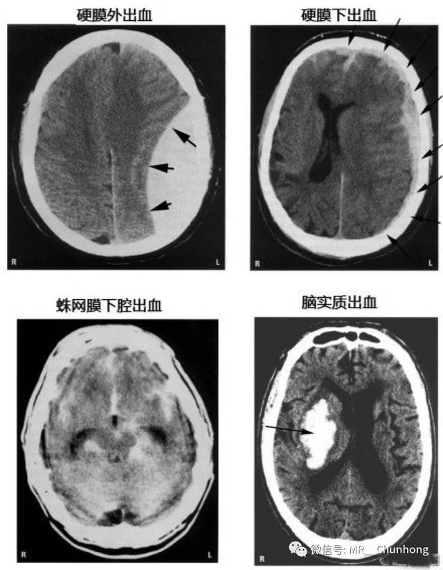 硬膜外与硬膜下出血的血来自哪里