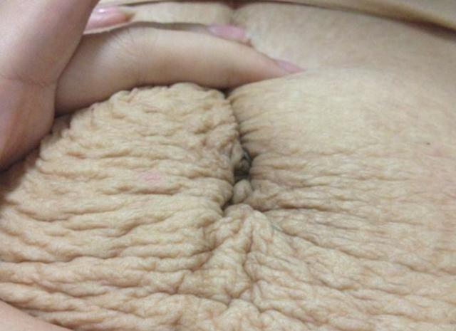 你的育儿经|剖宫产术后要“平躺去枕”？医生：旧观念已过时，怎么舒服怎么来