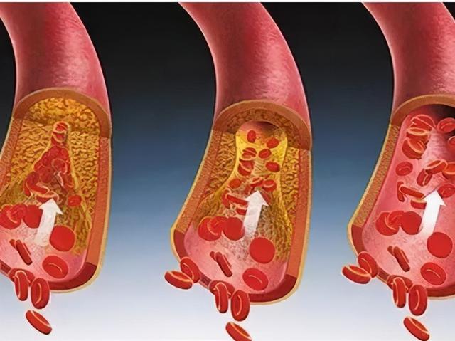 保持血管健康，预防动脉粥样硬化