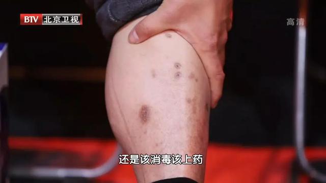 肺脓肿|“假肺癌”可能引发全身中毒、 肺部大出血！老年人和糖友需警惕