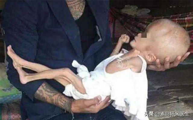 『你的育儿经』过敏宝宝的家长请注意！又见“大头娃娃”，害人的假奶粉还在卖