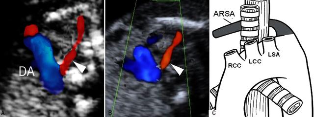 你的育儿经|明明白白做超声24-1:胎儿早期非整倍性染色体疾病筛查2