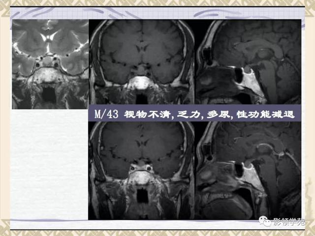 垂体病变的MRI诊断