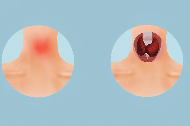 甲状腺癌发起火来，也不是善茬，4个危害可能会跟随而来