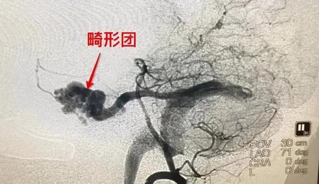 18岁学生拔河拔到脑出血！医生：排便、打麻将也要小心