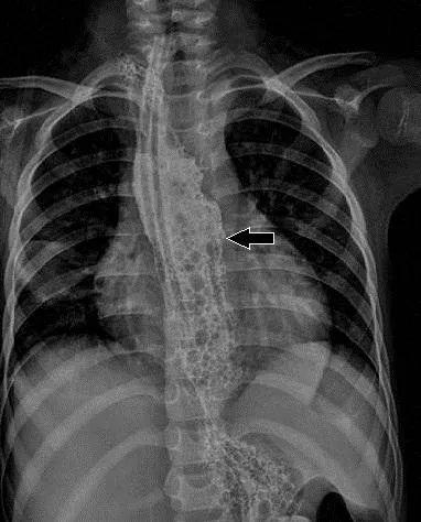 食管|广东9岁女孩喝了桌上“一口水”，致食管萎缩无法进食......