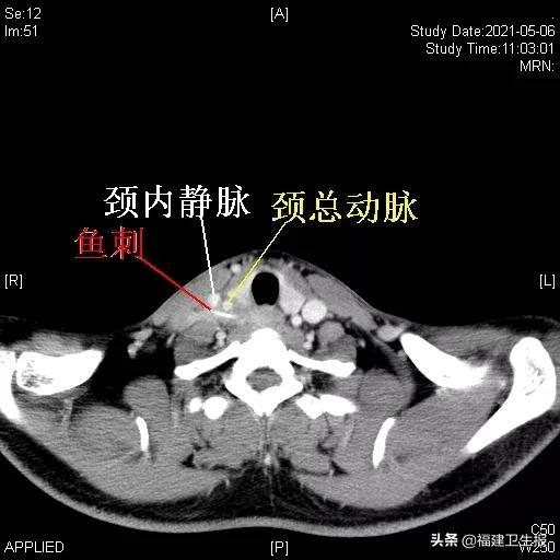 鱼刺|福州小伙吞鱼刺后忘了，2年后他的脖子肿起一个大包……