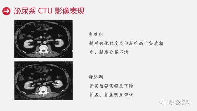 泌尿系CTU扫描技术