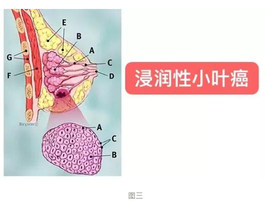 乳腺癌到底从哪里来